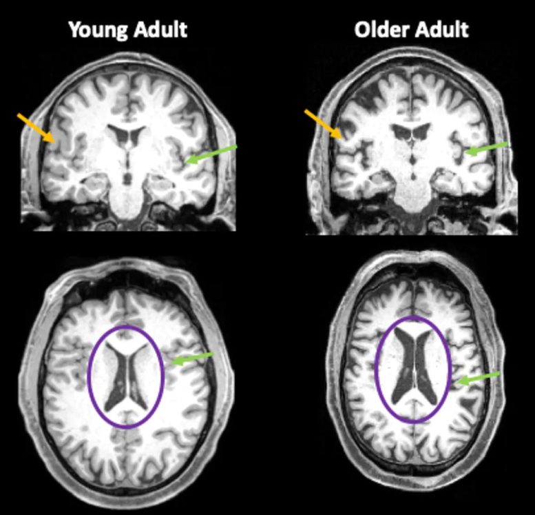年轻人和老年人的大脑图像