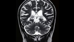 前脑扫描MRI图像