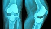 膝关节置换手术X线片