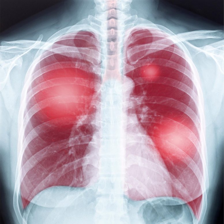 肺部疾病胸片