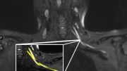 MRI显示颈部的Covid-19神经损伤