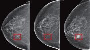 机器学习可以预测乳房x光片的癌症风险