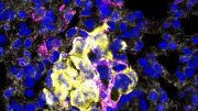 转移性乳腺癌细胞