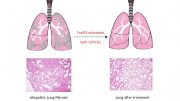 研究人员揭示了肺纤维化的原因