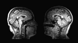 两个脑MRI扫描